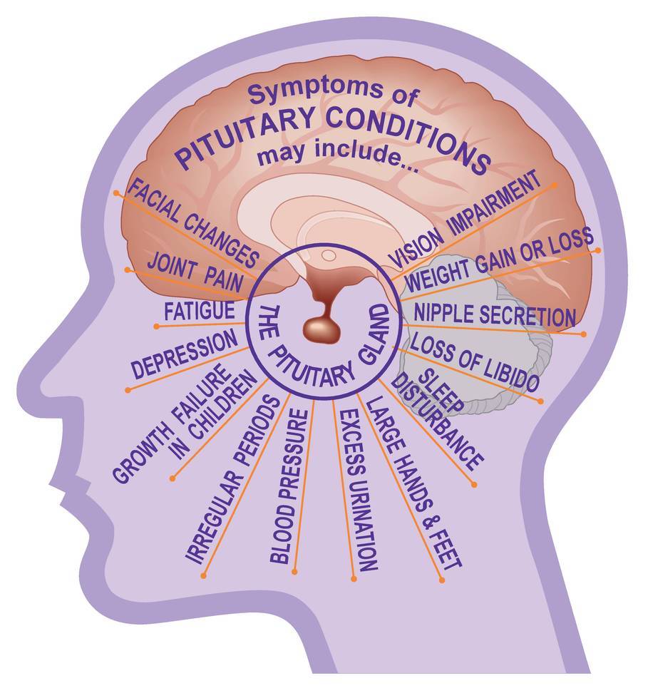 Pituitary Tumours Cancer Council Queensland 