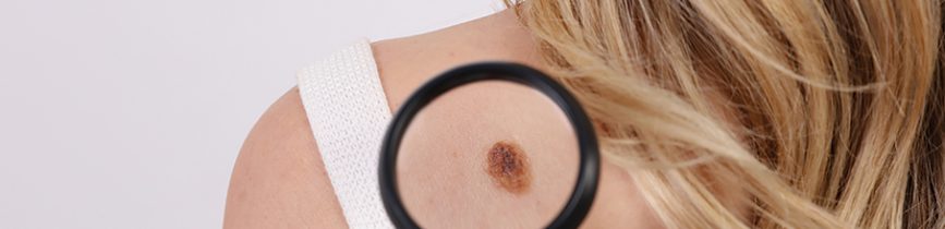 Research snapshot - Risk factors for the development of melanoma vary according to body site Laskar 2020